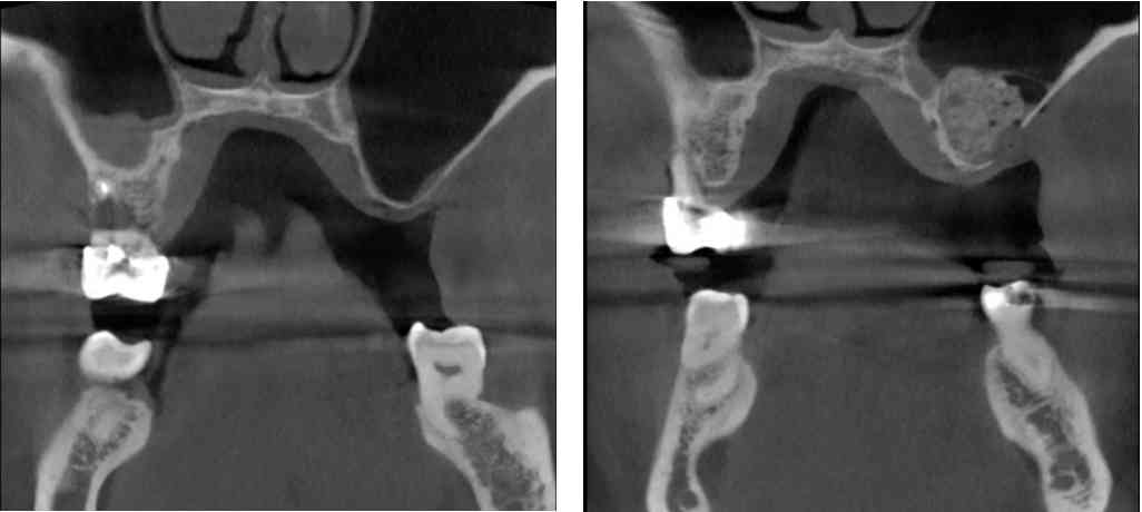 LA ELEVACIÓN DE SENO MAXILAR PARA IMPLANTES