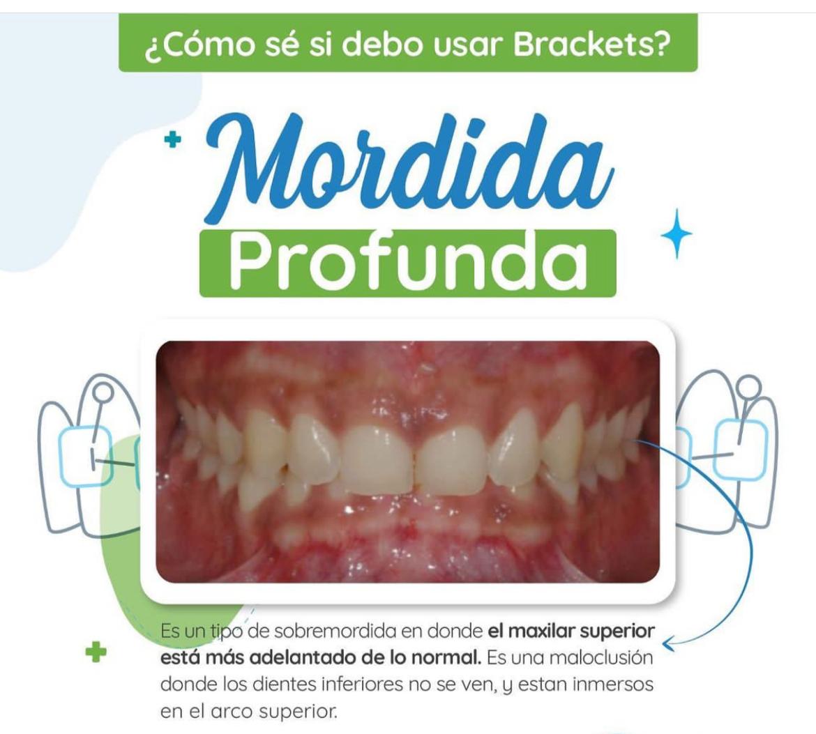 ¿Cómo sé si debo usar Brackets?