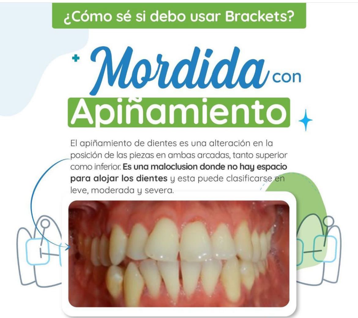 ¿Cómo sé si debo usar Brackets?