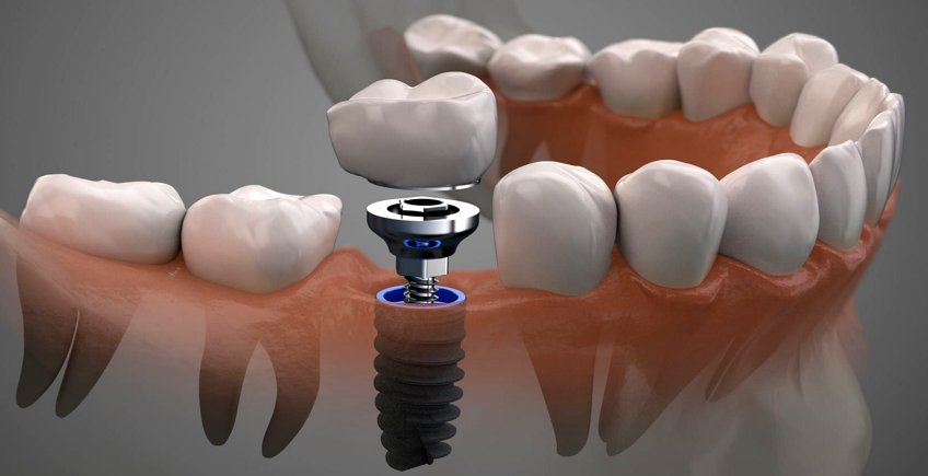 Preguntas frecuentes de los implantes dentales