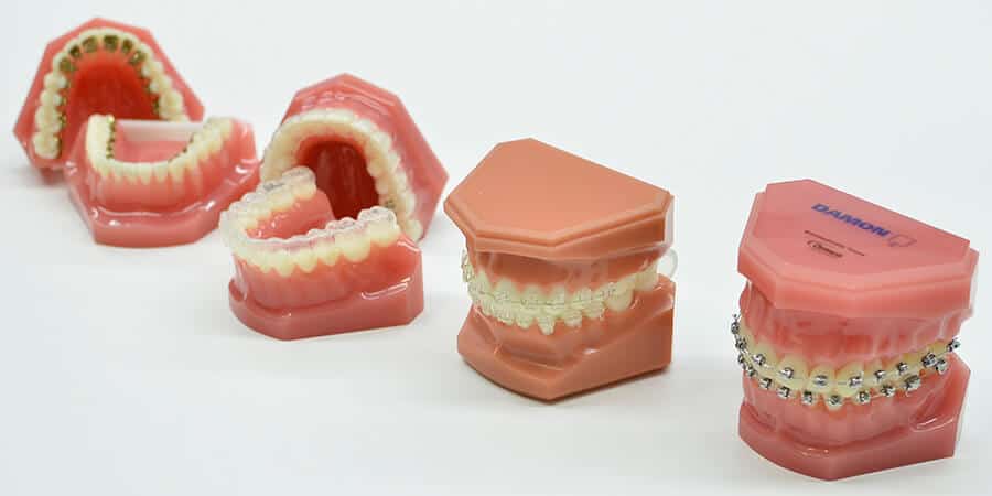 ¿Cómo se ponen los brackets? y hasta donde.