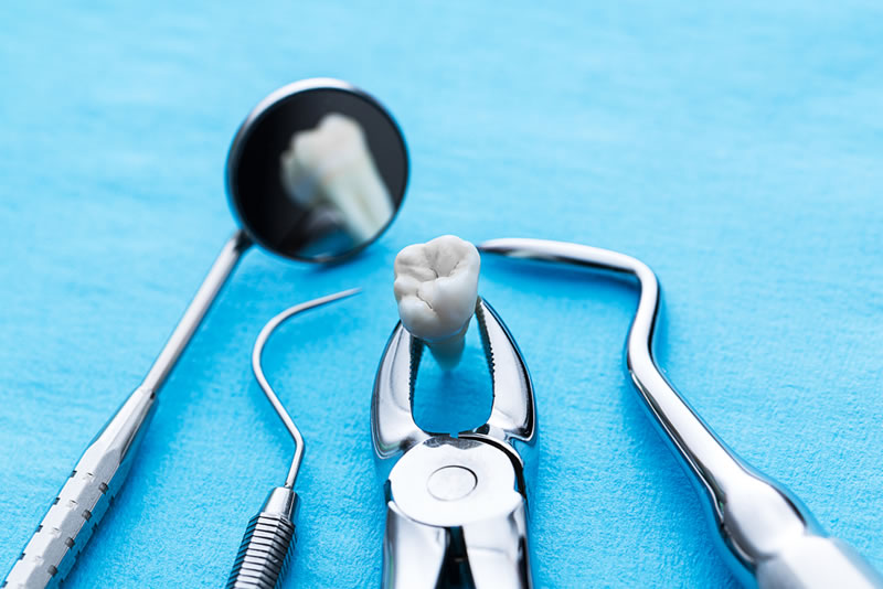 Recomendaciones para despues de una Extracción Dental