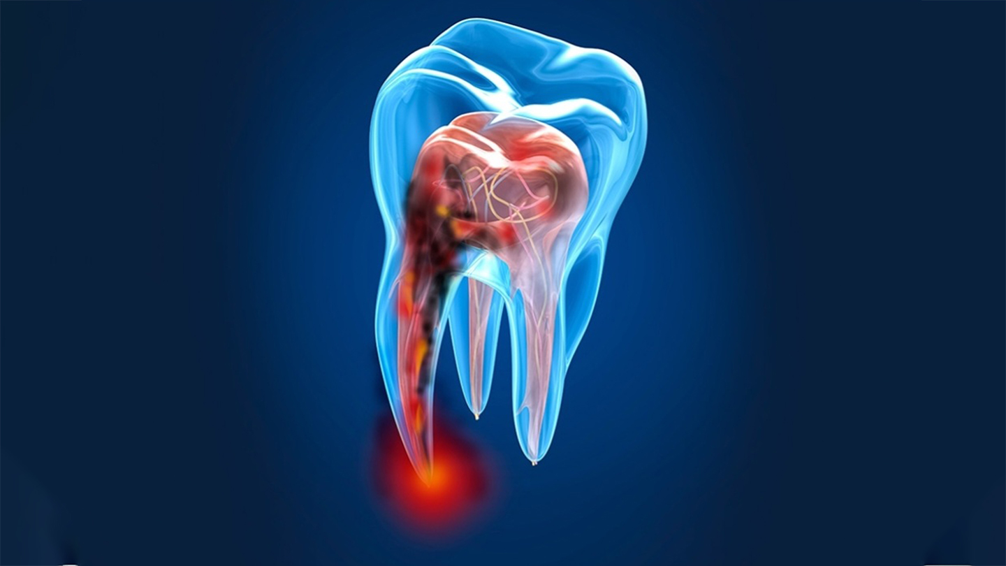 Endodoncia