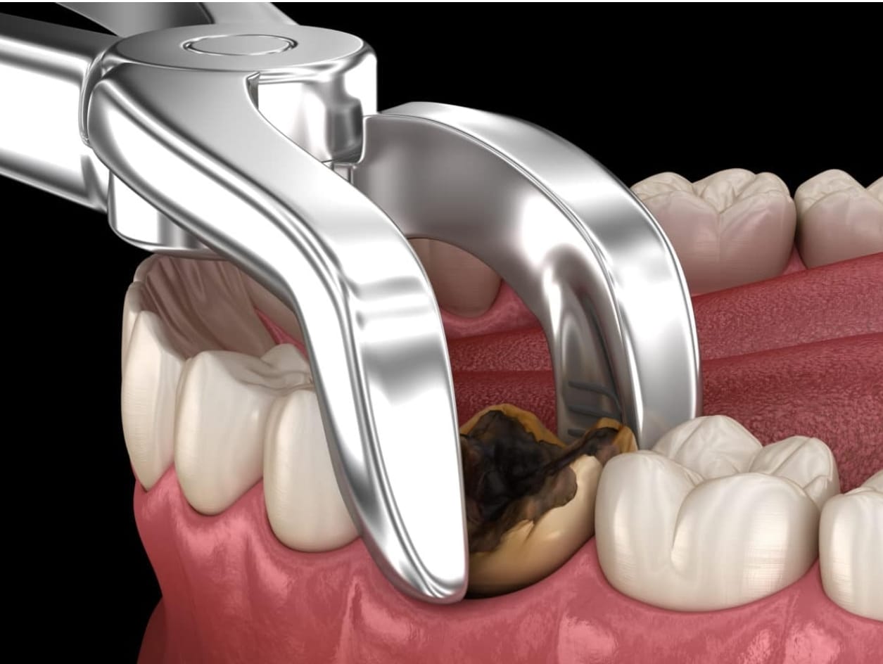 Extracción Dental