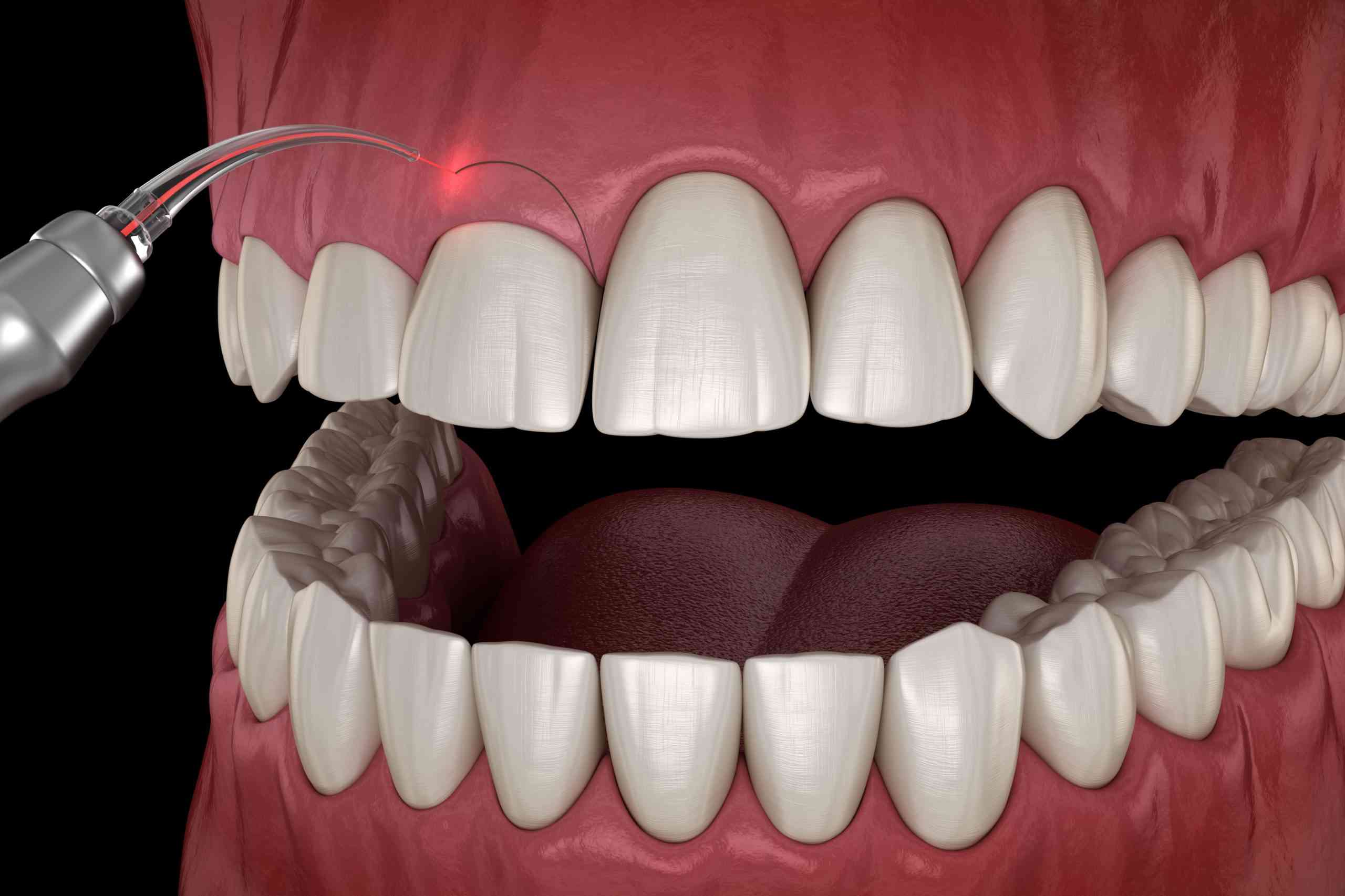 Gingivectomia o Gingivoplastia