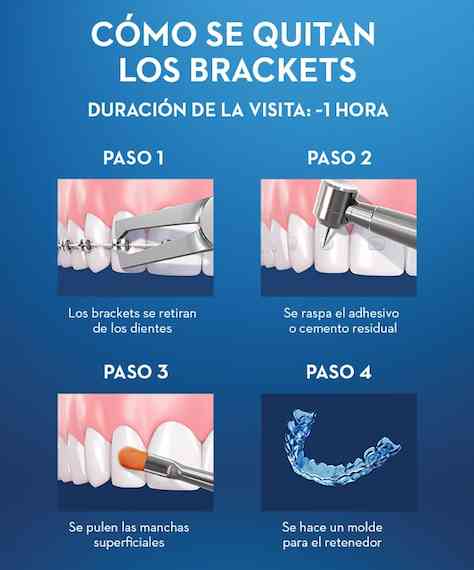 Retiro de Brackets Ortodoncia 