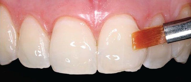 Fluor Dental Barniz
