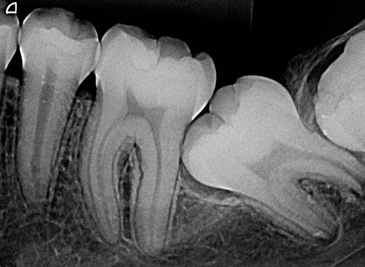RX Periapical